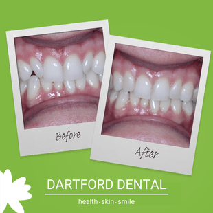 Patient before and after Invisalign 1