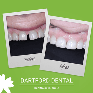 Patient before and after Invisalign 2