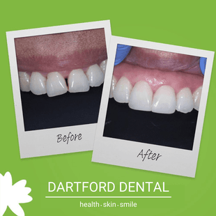 Patient before and after Invisalign 3